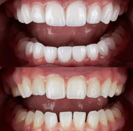 Clareamento Dental a Laser ou Caseiro